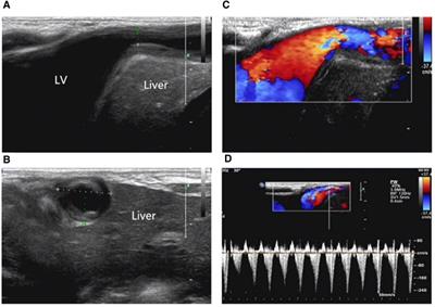 Clinical and ultrasound findings of pentalogy of Cantrell in a newborn: A case report